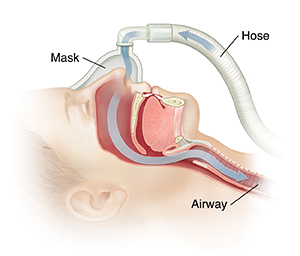 Side view of head with arrow showing path of air through CPAP mask into nose and airway.