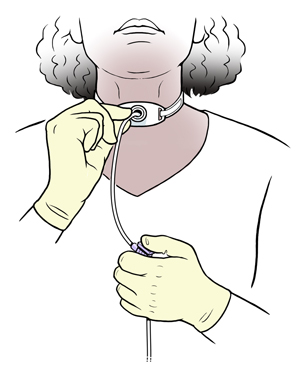 Woman inserting suction catheter into tracheostomy tube in neck.