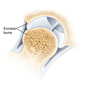 Cross section of hip joint showing abnormal bump of excess bone on ball of thighbone. Excess bone is also on lip of socket.