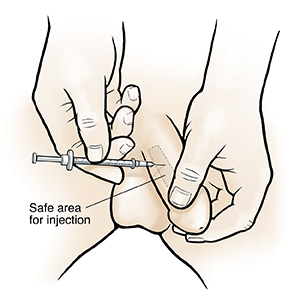 Closeup of hands giving injection into side of penis.