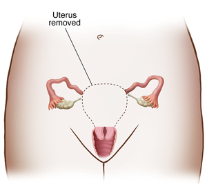 Front view of woman's pelvis showing reproductive tract. Dotted line shows organs removed in subtotal hysterectomy.