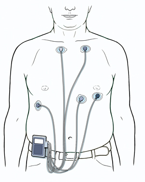 Man's torso showing five ECG leads attached to chest and connected to Holter monitor clipped to belt.