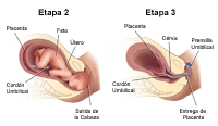 Trabajo de parto en etapas 2 y 3