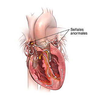 Corte transversal de vista frontal de un corazón con arritmia.